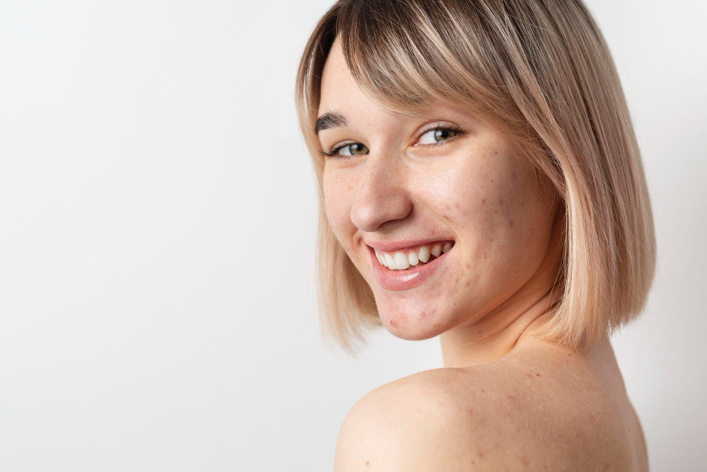 Acne Prone Skin