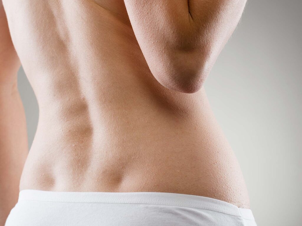 Laser Hair Removal — Lower Back - Course of 6 treatments