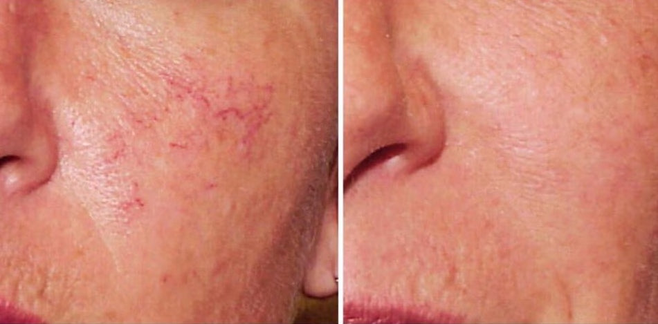 Thread Vein Removal — Cheeks and Nose - Course of 3 treatments