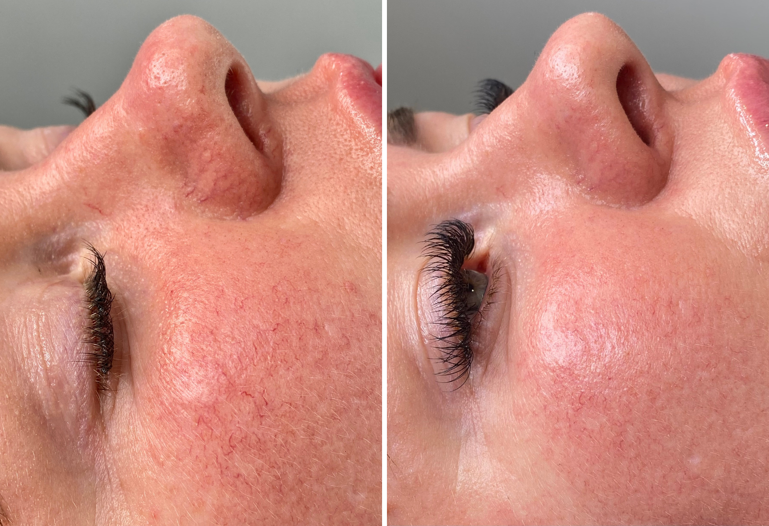 Thread Vein Removal — Full Face - Course of 3 treatments