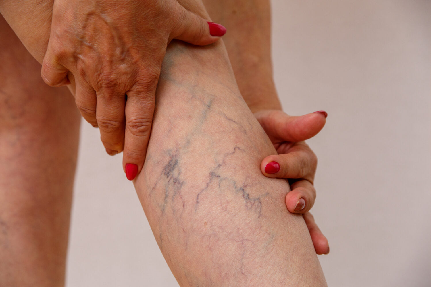 Thread Vein Removal — Legs (small area) - Course of 3 treatments